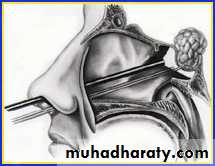 PARATHYROID NEW