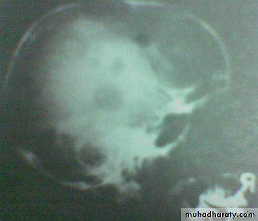 PARATHYROID NEW