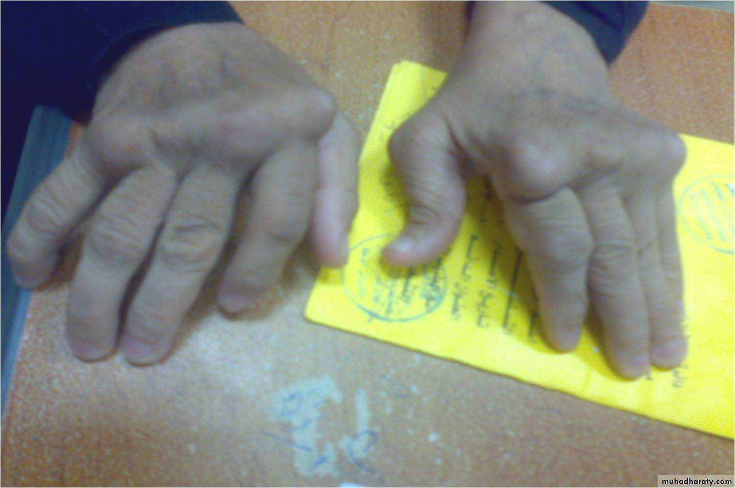 Crystals associated diseases 3