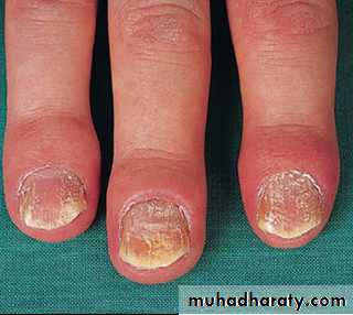 Crystals associated diseases 3