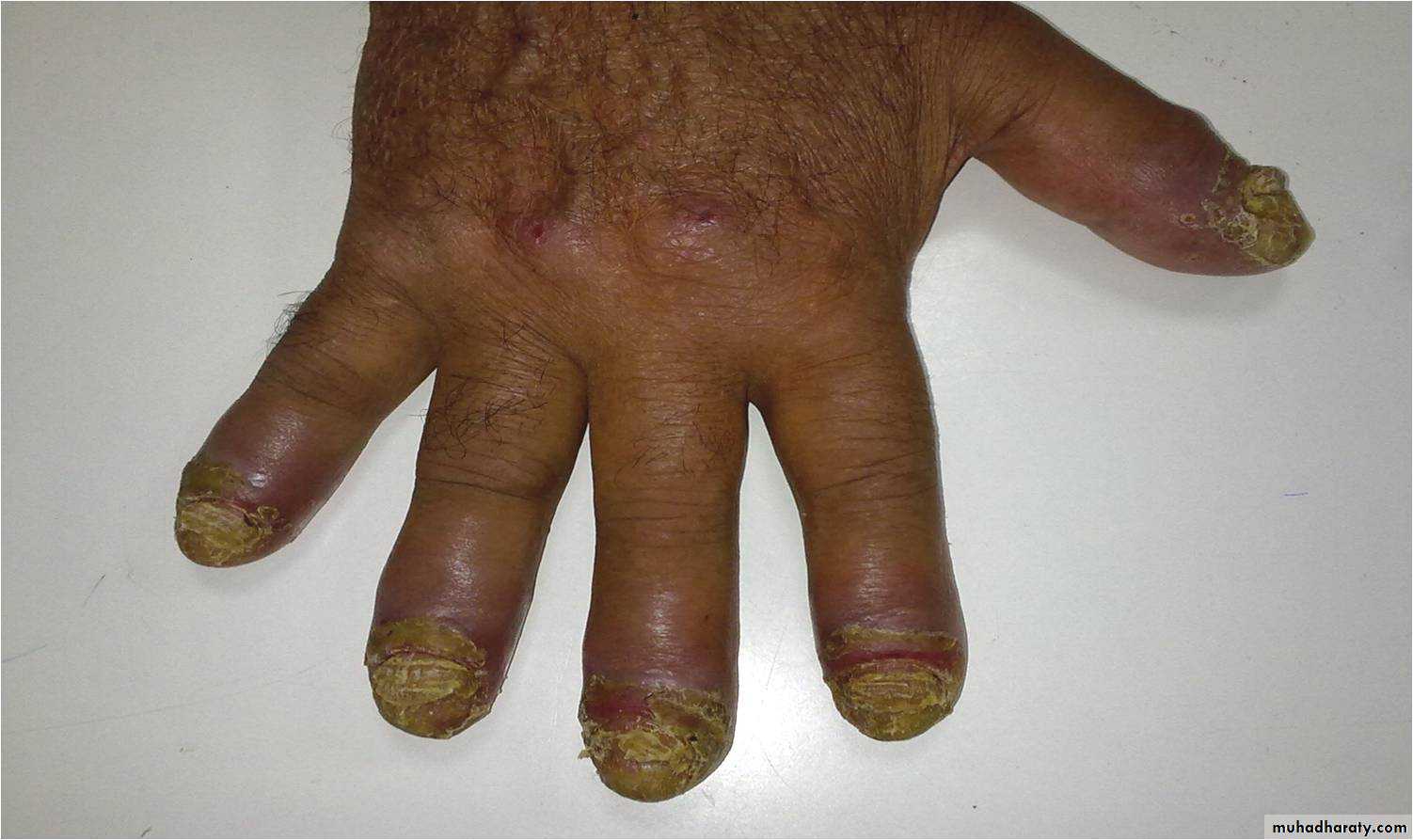 Crystals associated diseases 3