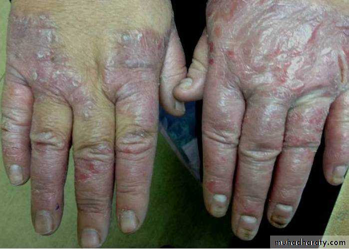 Crystals associated diseases 3