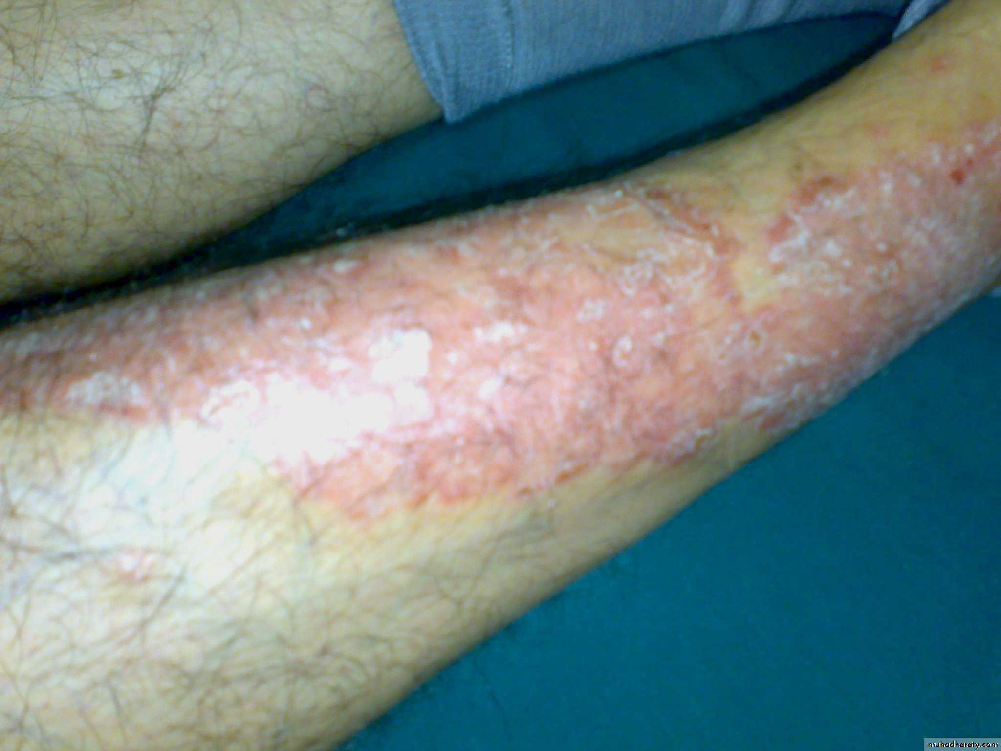 Crystals associated diseases 3