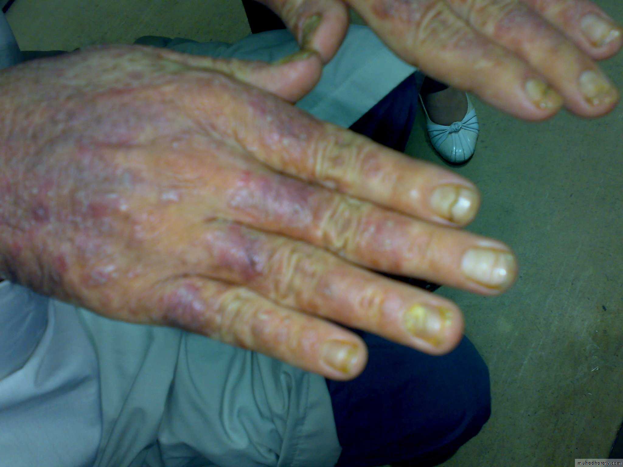 Crystals associated diseases 3
