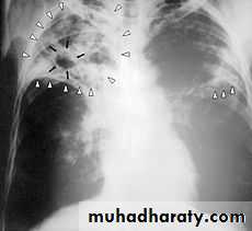 Crystals associated diseases 3