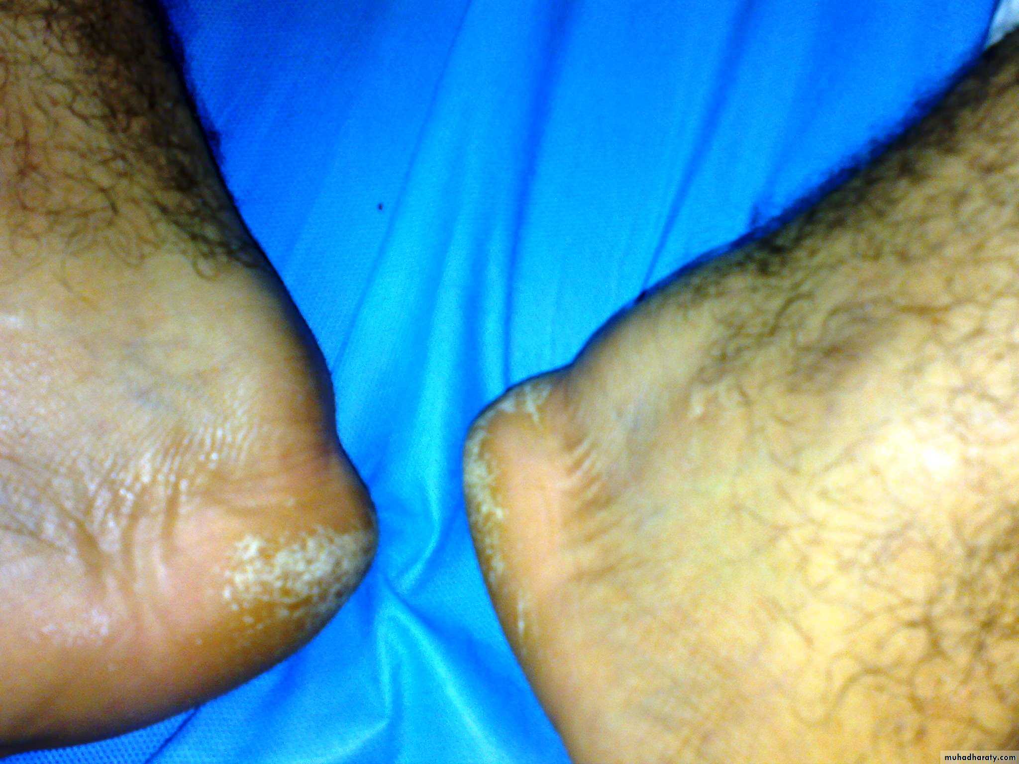 Crystals associated diseases 3