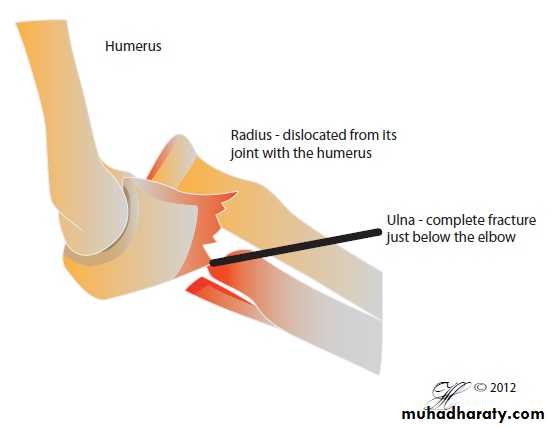 Fractures of the radius and ulna