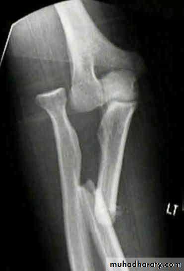 Fractures of the radius and ulna