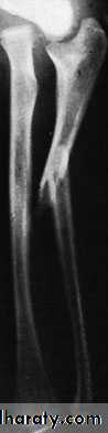 Fractures of the radius and ulna