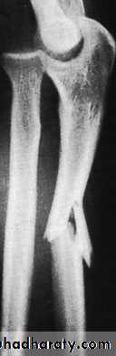 Fractures of the radius and ulna