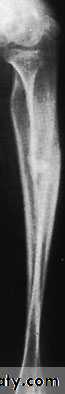 Fractures of the radius and ulna