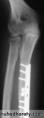 Fractures of the radius and ulna