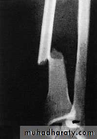 Fractures of the radius and ulna