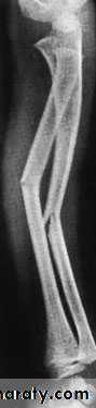 Fractures of the radius and ulna