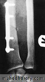Fractures of the radius and ulna
