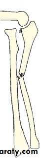 Fractures of the radius and ulna