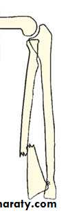 Fractures of the radius and ulna