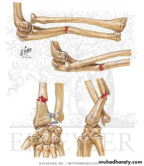 Fractures of the radius and ulna