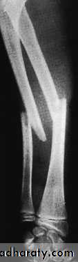 Fractures of the radius and ulna