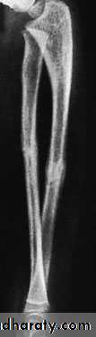 Fractures of the radius and ulna
