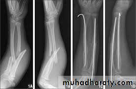 Fractures of the radius and ulna