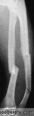 Fractures of the radius and ulna
