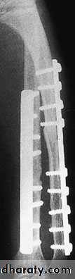 Fractures of the radius and ulna