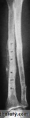 Fractures of the radius and ulna
