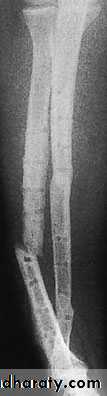 Fractures of the radius and ulna
