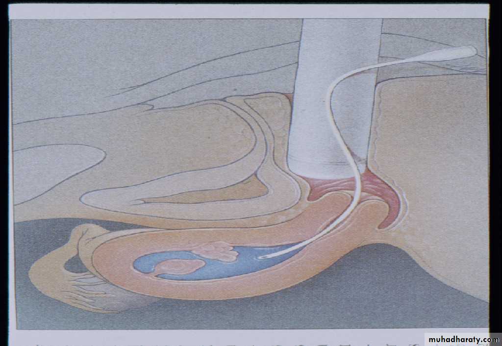 Post Menopausal Bleeding
