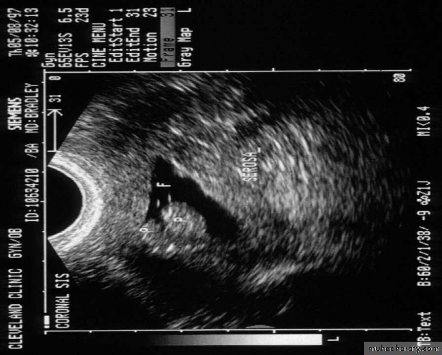 Post Menopausal Bleeding