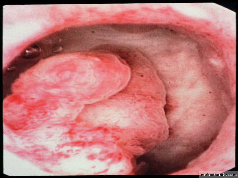 Post Menopausal Bleeding