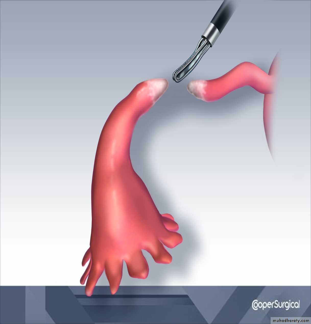 sterilization