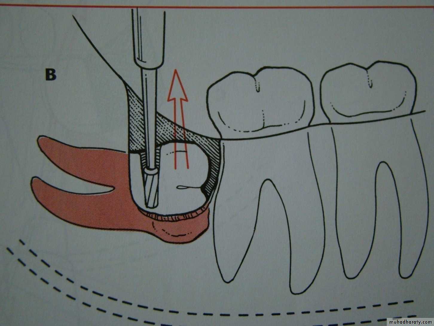 Impaction