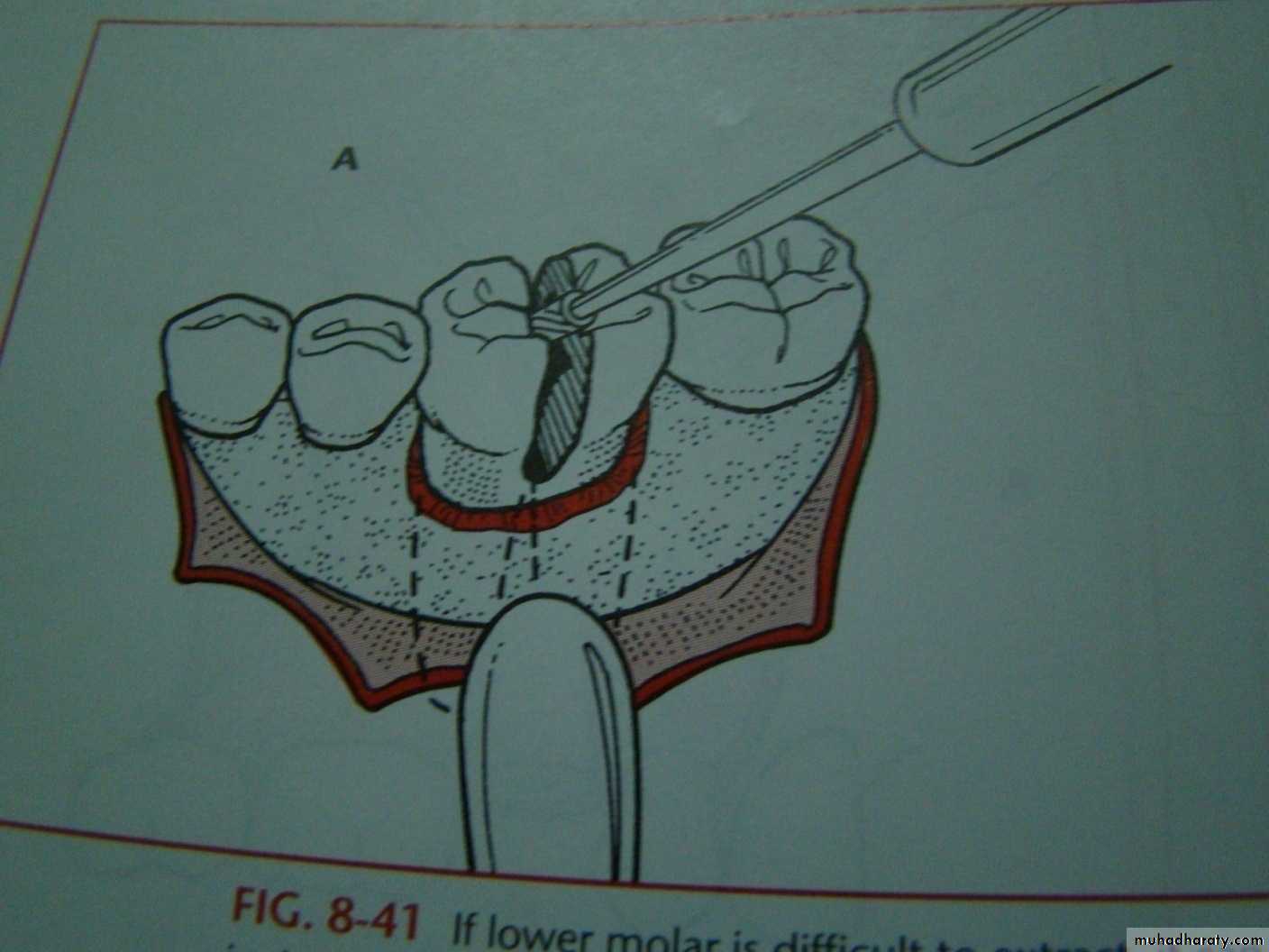 Impaction