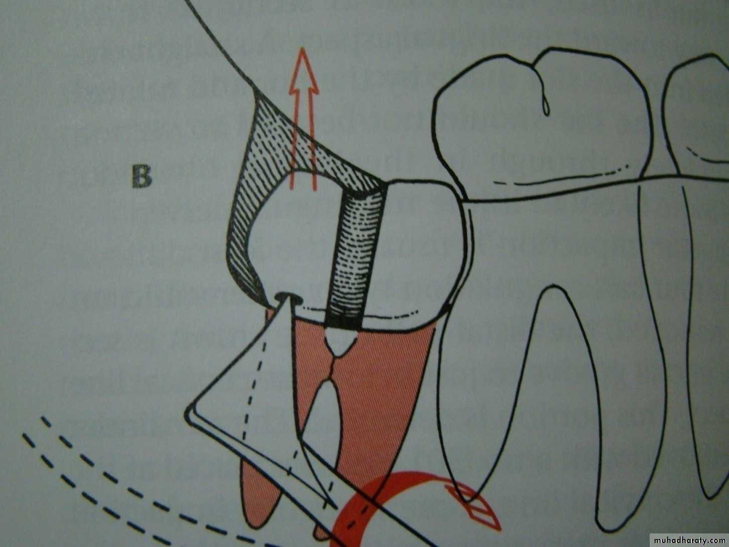Impaction