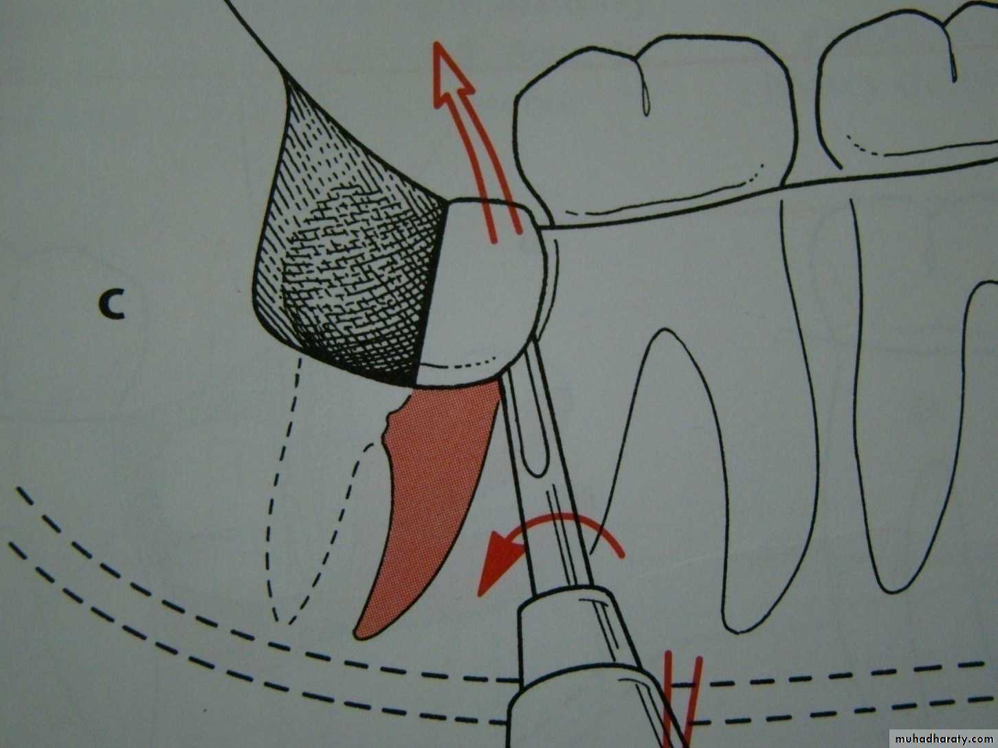 Impaction