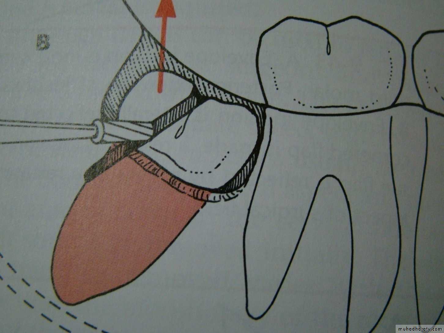 Impaction