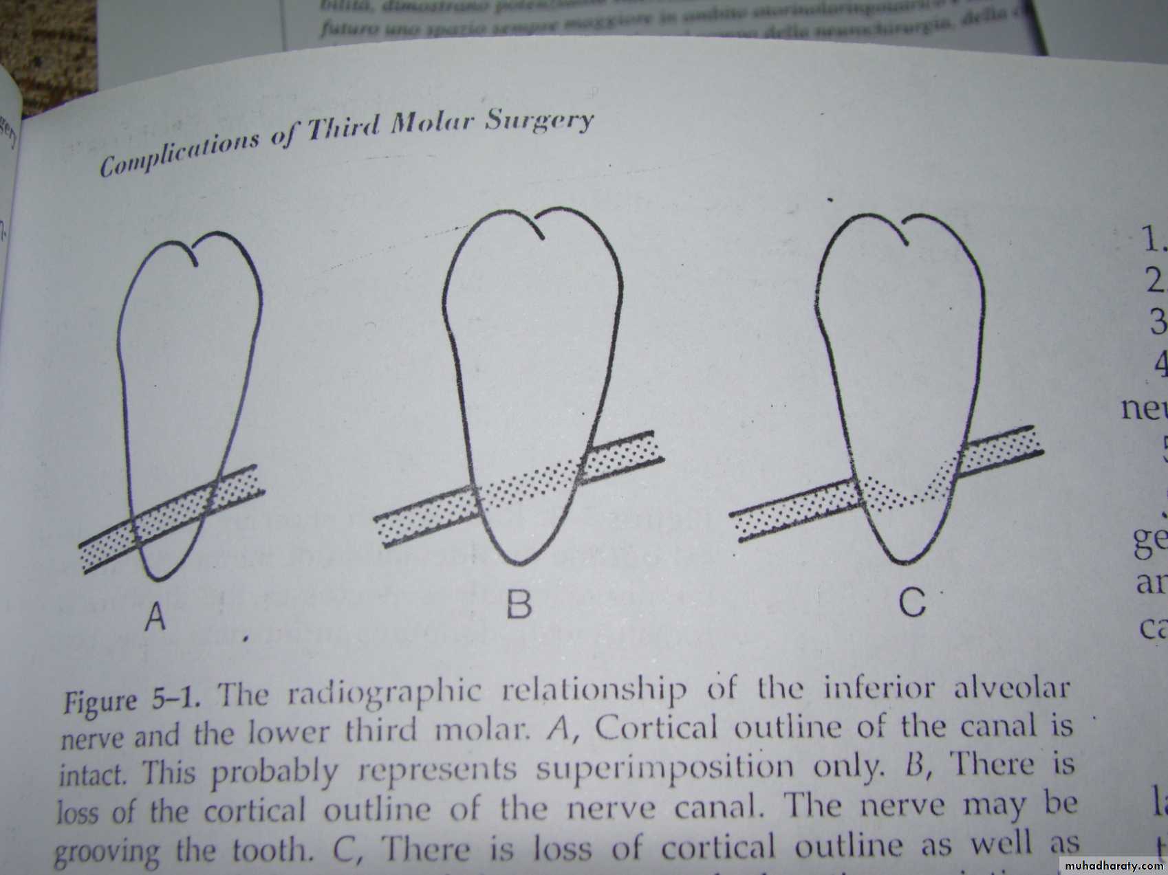 Impaction