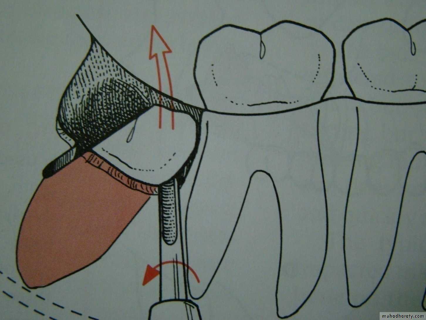 Impaction