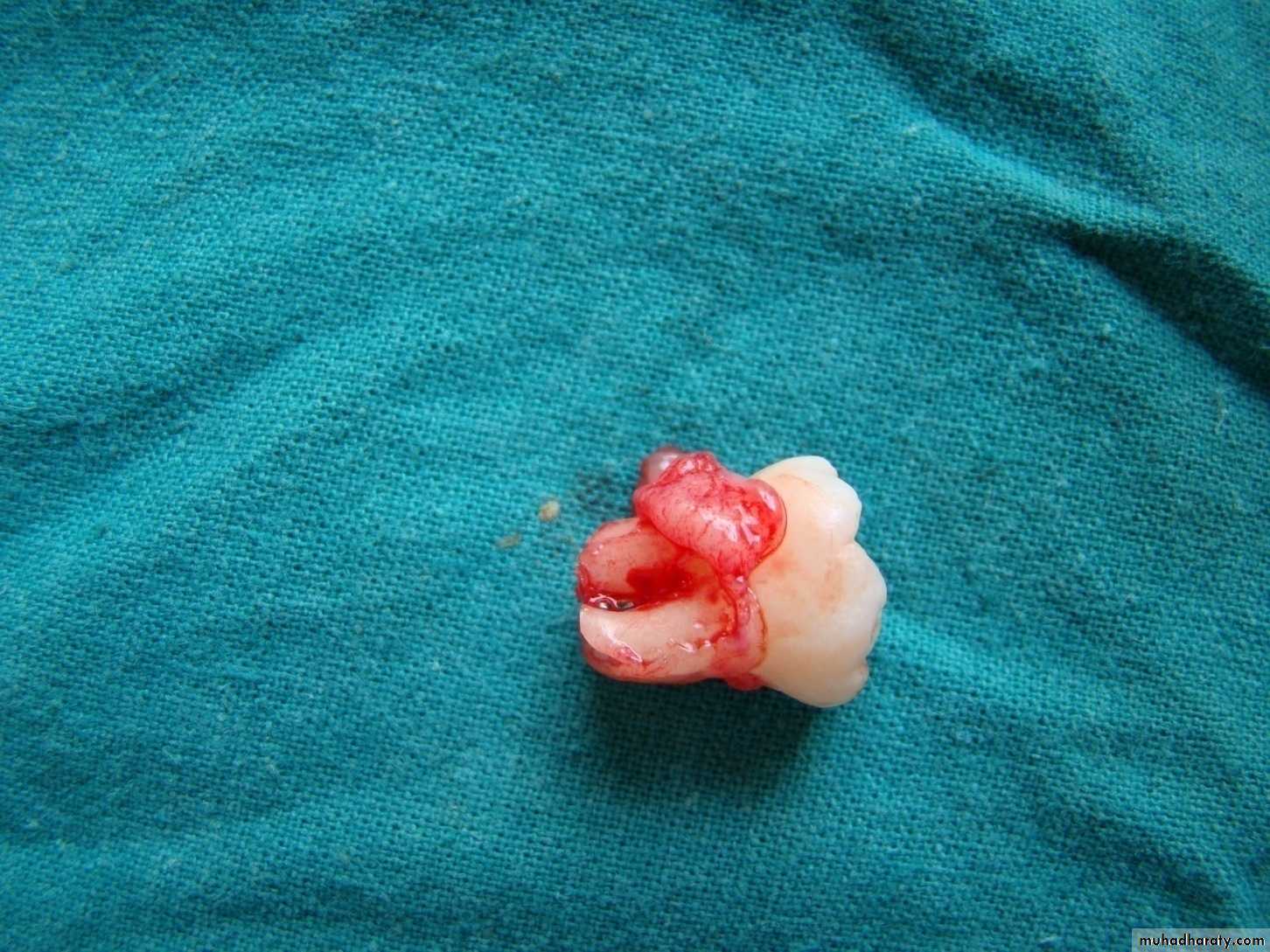 Impaction