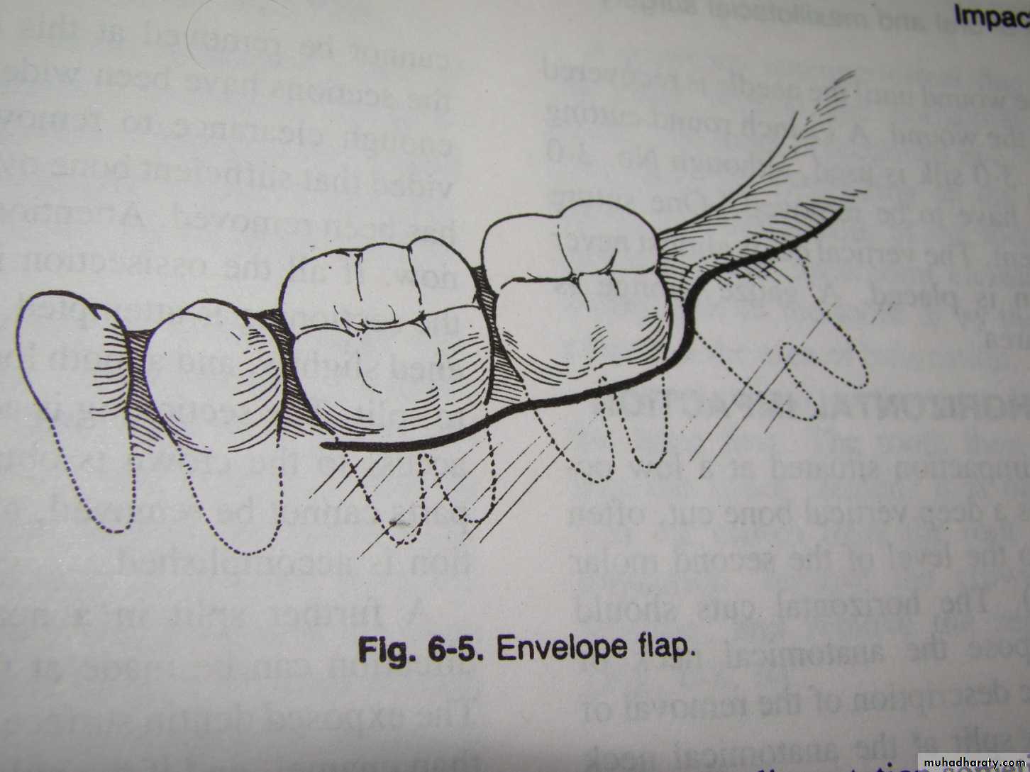 Impaction