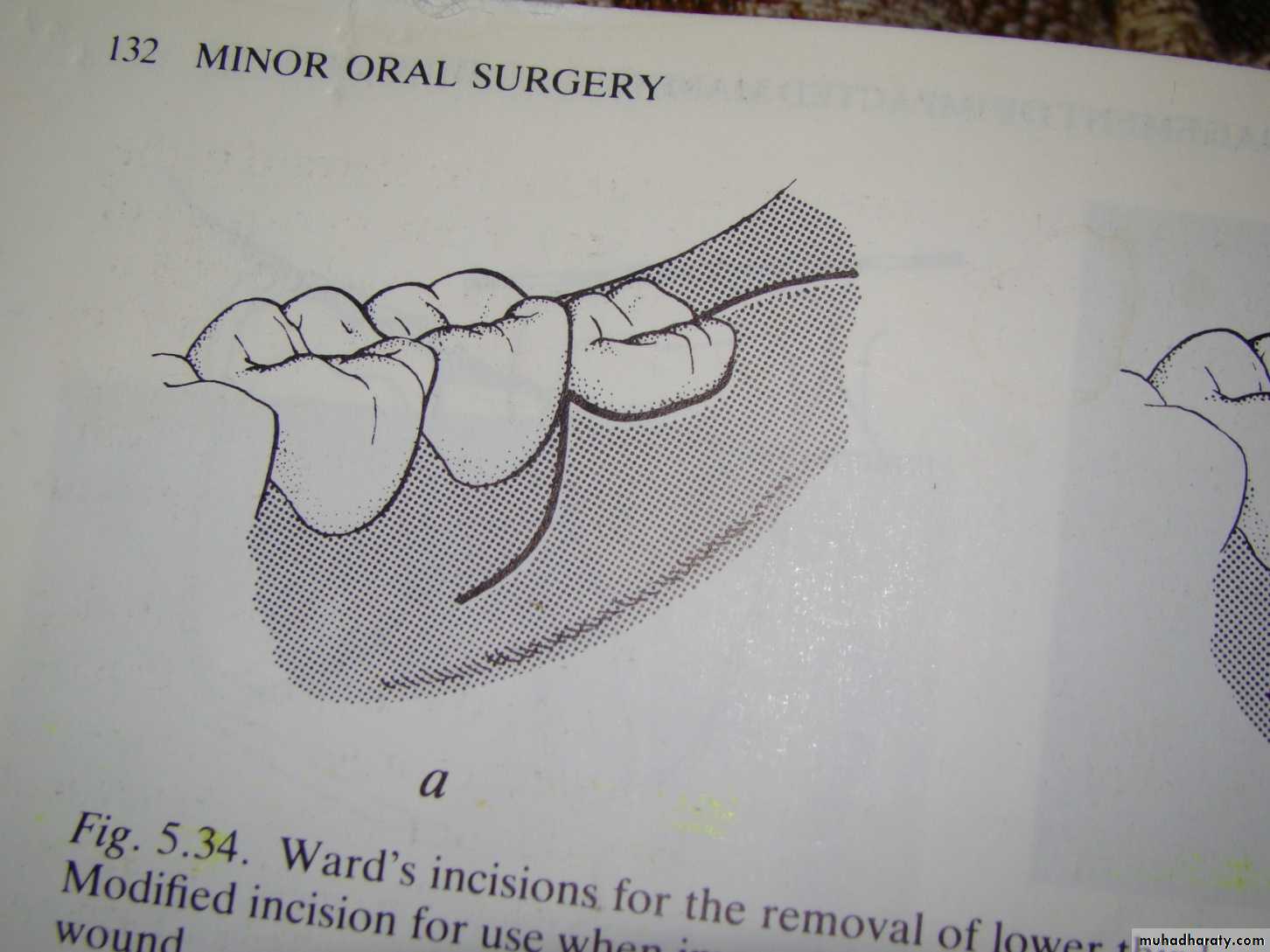 Impaction