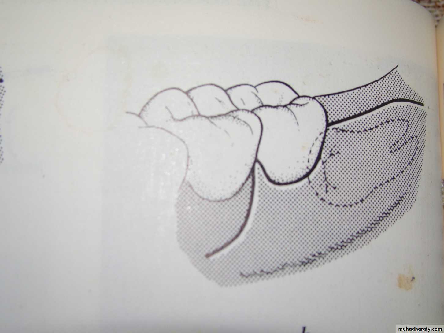 Impaction