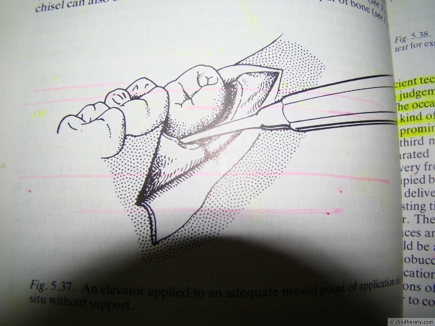 Impaction