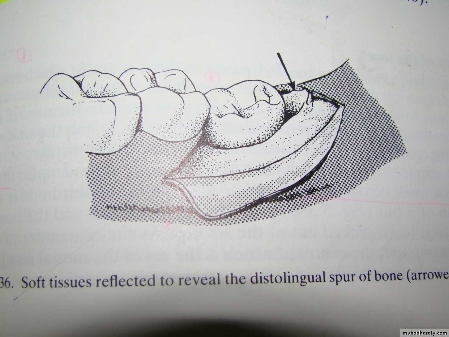Impaction