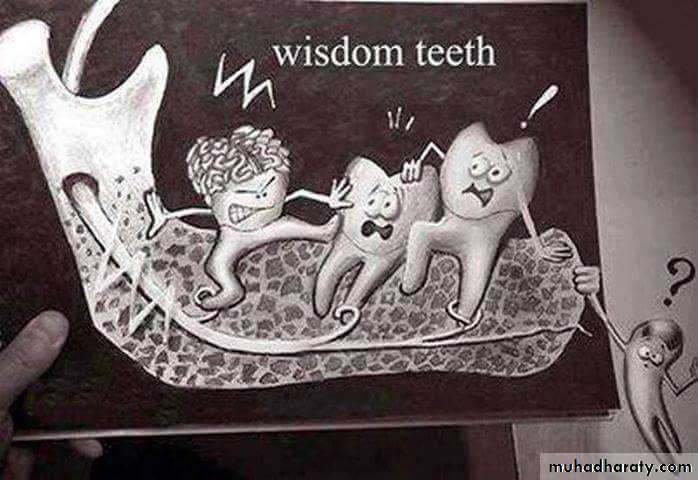 Impaction