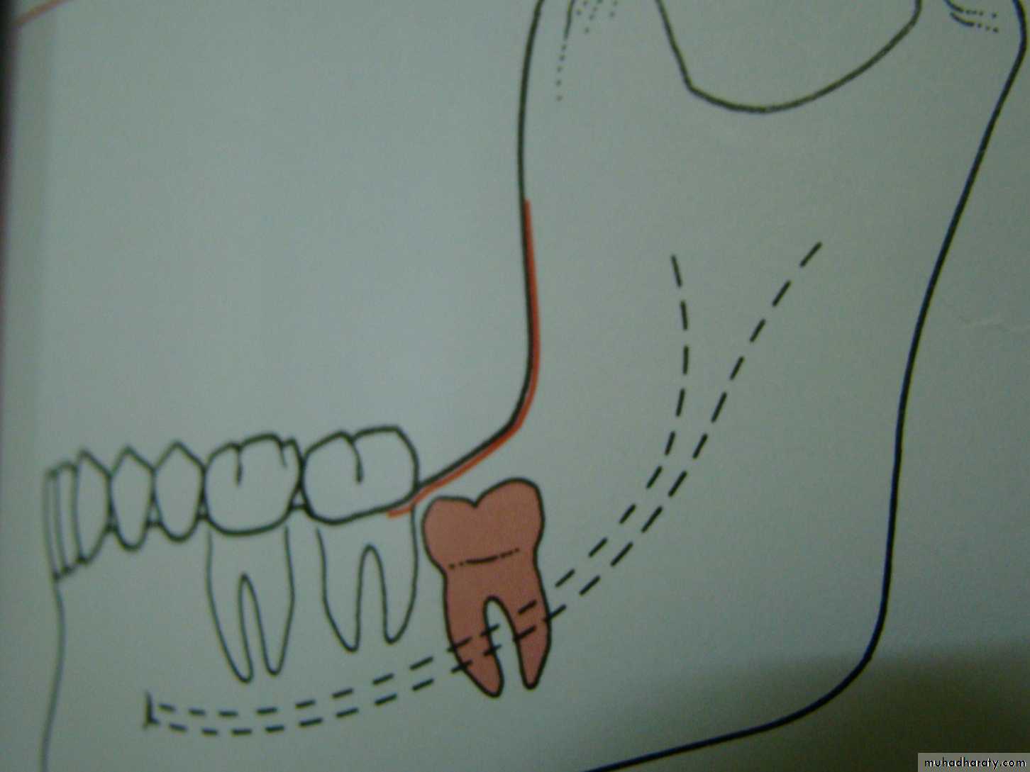 Impaction