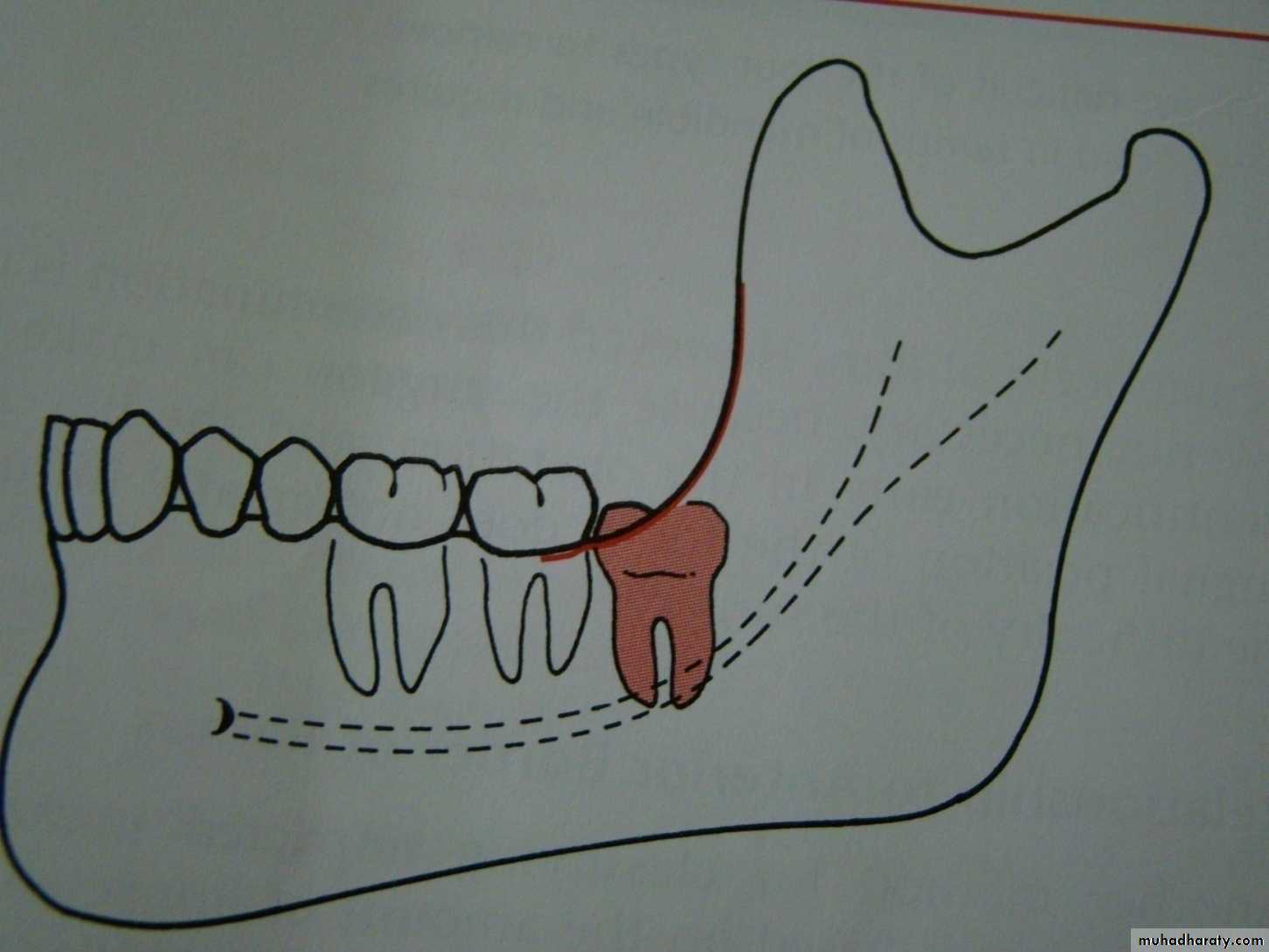 Impaction