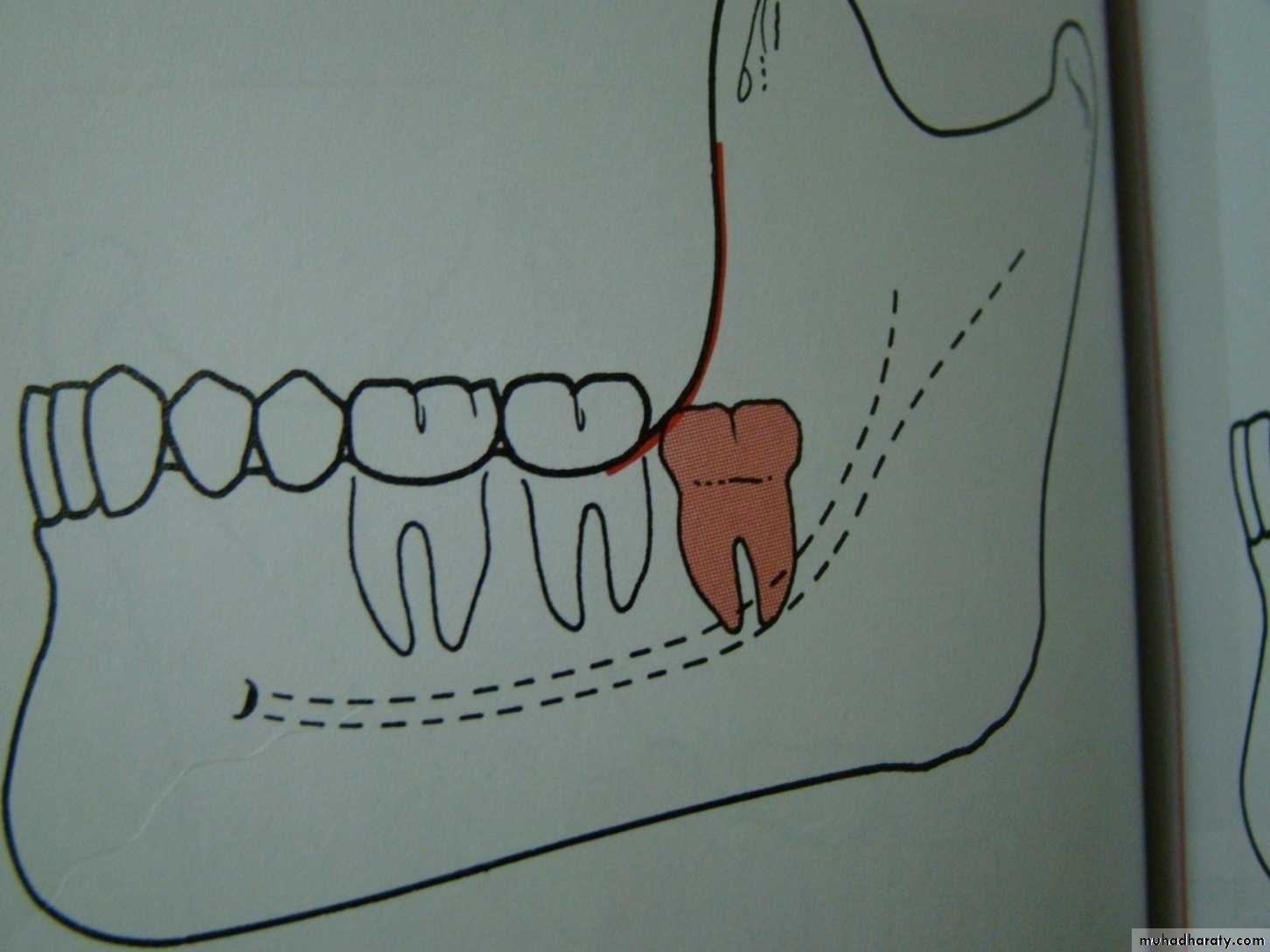 Impaction